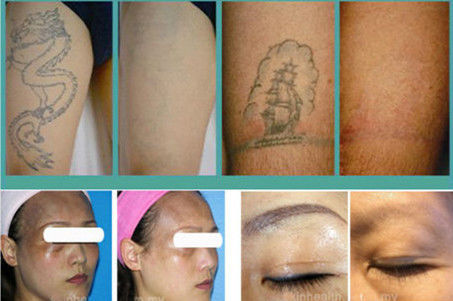 talla 2 blanca y gris del punto de laser, removedor de c4q conmutado del tatuaje de la energía de laser del ND YAG de 8m m